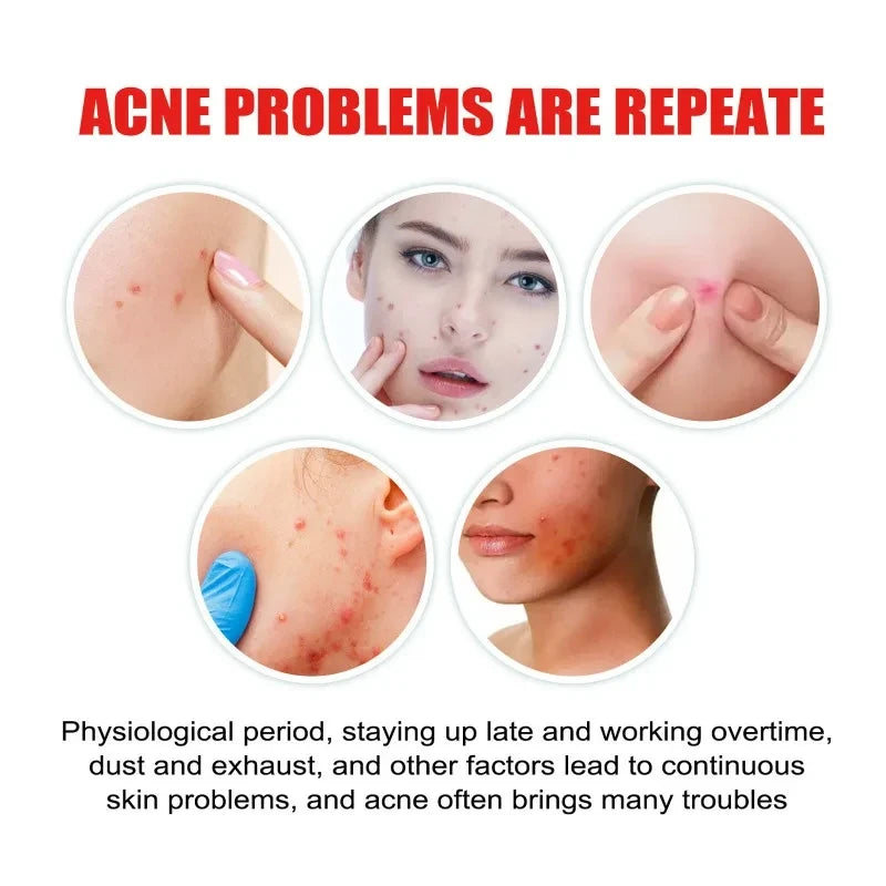 400pcs Star Acne Patches