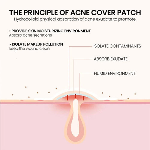 400pcs Star Acne Patches